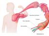 Мышечная крепатура: причины появления и способы снятия